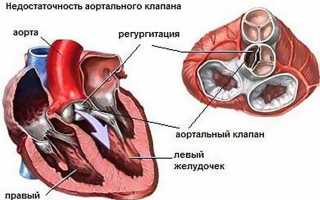 Регургитация на аортальном клапане 1 степени