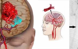 Как лечить хроническую ишемию головного мозга