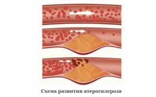 Стенозирующий атеросклероз коронарных артерий