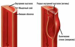 Расслаивающаяся аневризма брюшного отдела аорты