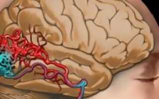 Кавернозная ангиома головного мозга лечение