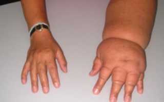 Профилактика лимфостаза руки после мастэктомии