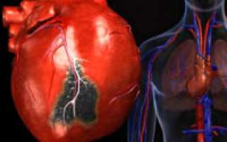 Расширение полости левого желудочка сердца