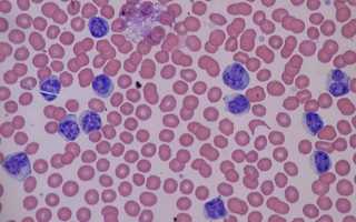 Высокие лимфоциты в крови у взрослого причины