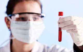 Ревматоидный фактор в анализе крови расшифровка
