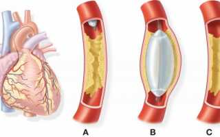 Реабилитационный период после инфаркта миокарда