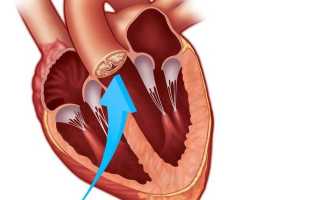 Признаки недостаточности аортального клапана