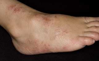 Сухая болезненная кожа голени при варикозе
