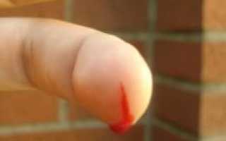 Ребенок порезал палец как остановить кровь